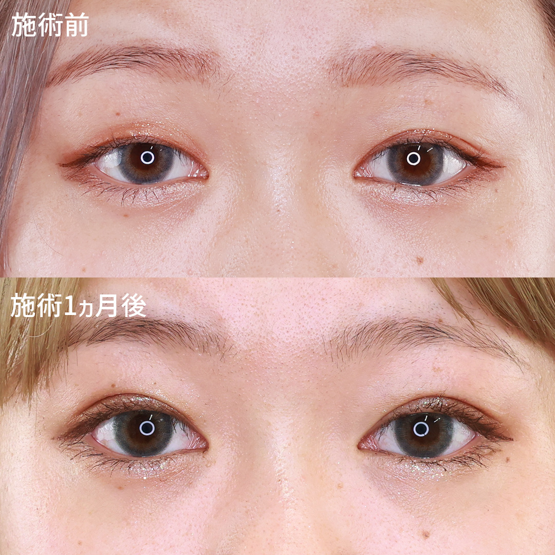 自信が持てるお目元は埋没法×脱脂で作ります！