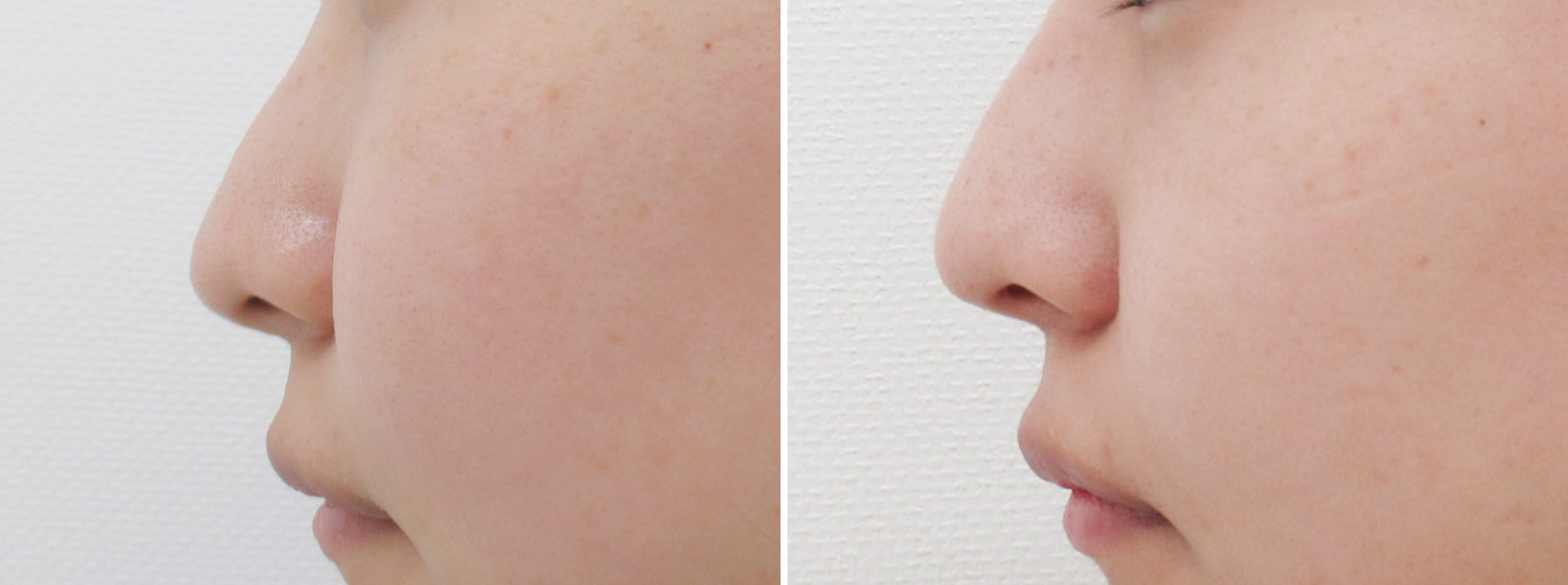 鼻尖4dノーズの症例 鼻整形 小鼻整形の症例情報一覧 ダウンタイム Taクリニック 美容整形 美容外科