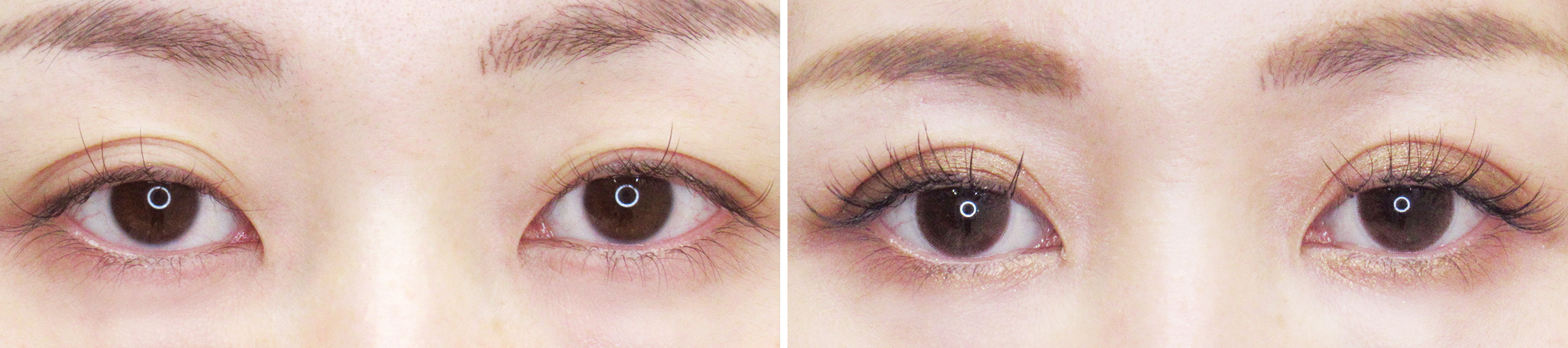 クイックコスメリング －短いダウンタイムで理想の二重－