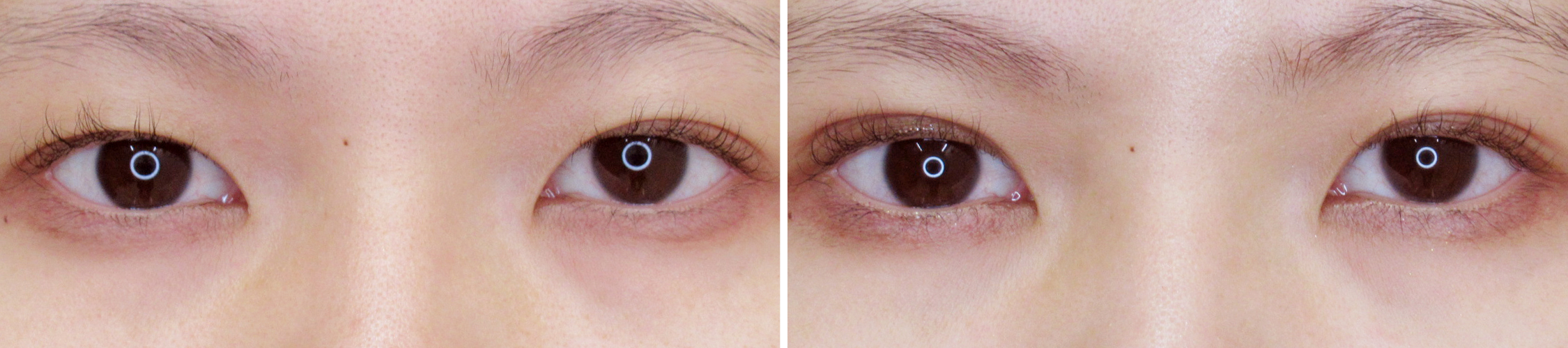 クイックコスメリングで目元の左右差を調整