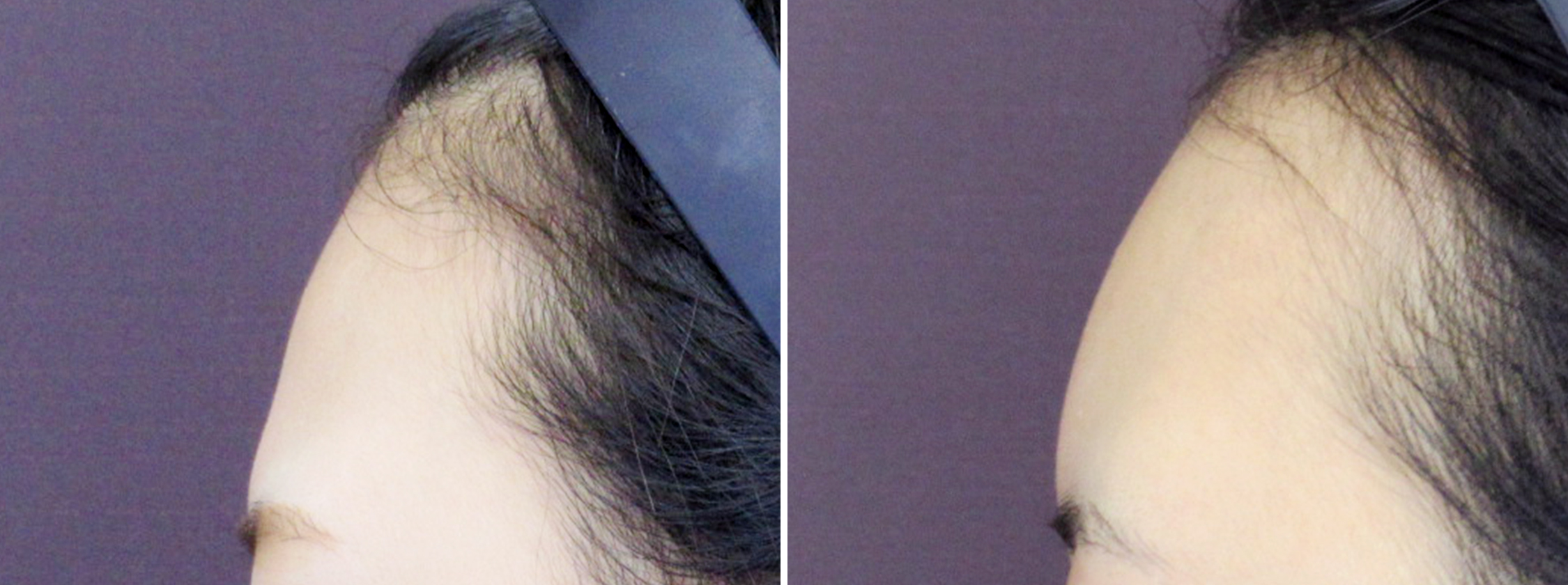 おでこの脂肪注入で愛らしさUP！