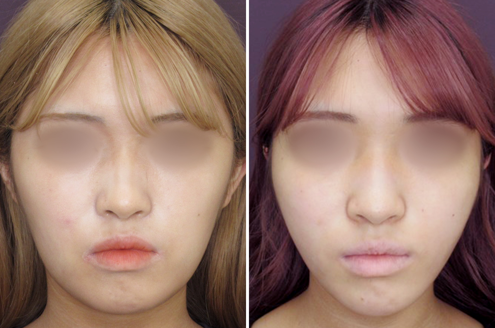 TAC式ツヤ肌コラーゲンリフト®で　しっかり引き上げて別人のような輪郭に