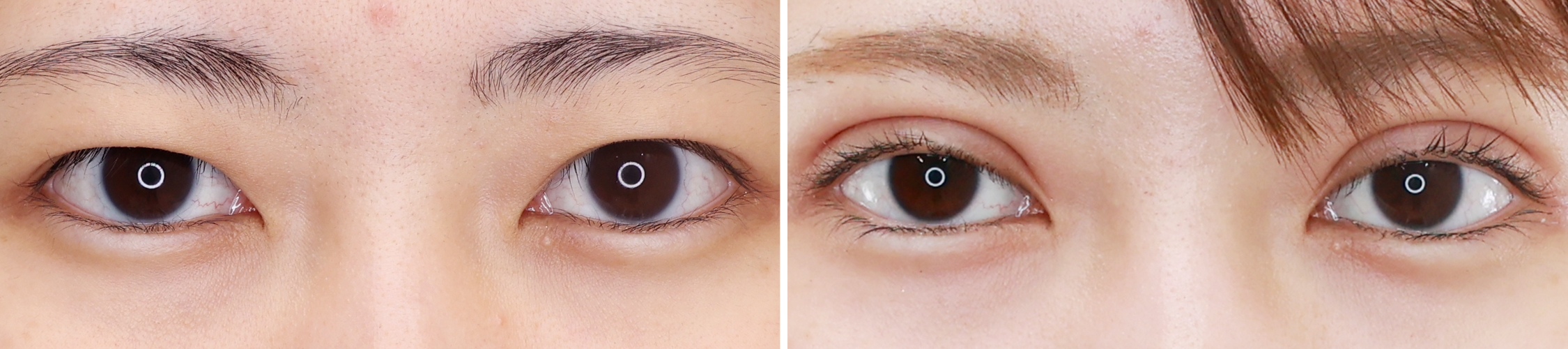 二重埋没法で新しい目元に