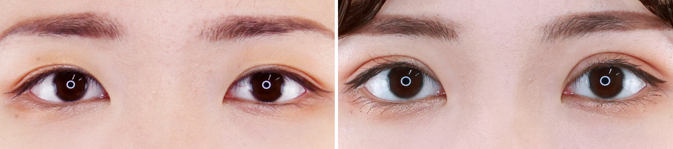 上眼瞼切開術でたるみまぶたを解消！