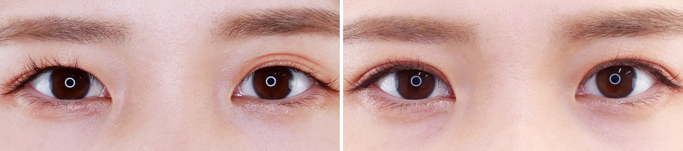 幅狭二重でも左右差を無くすことで美人度上昇！