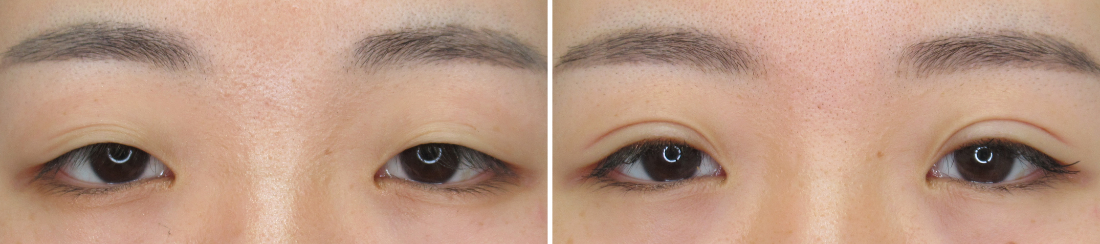 くっきり二重になって憧れのお目元に近づく