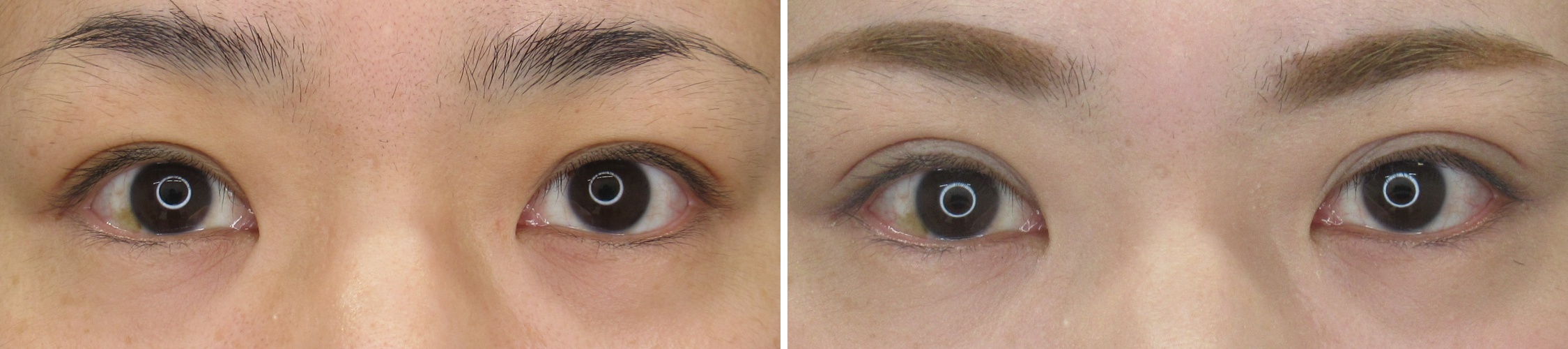 埋没法で理想の二重