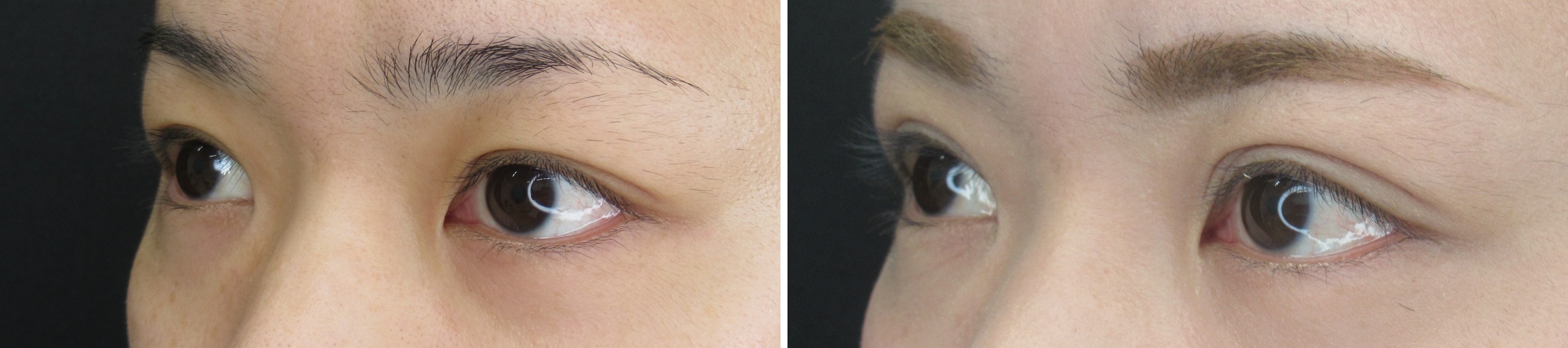 二重埋没法/目元：その他の症例写真 施術前後 １ヵ月