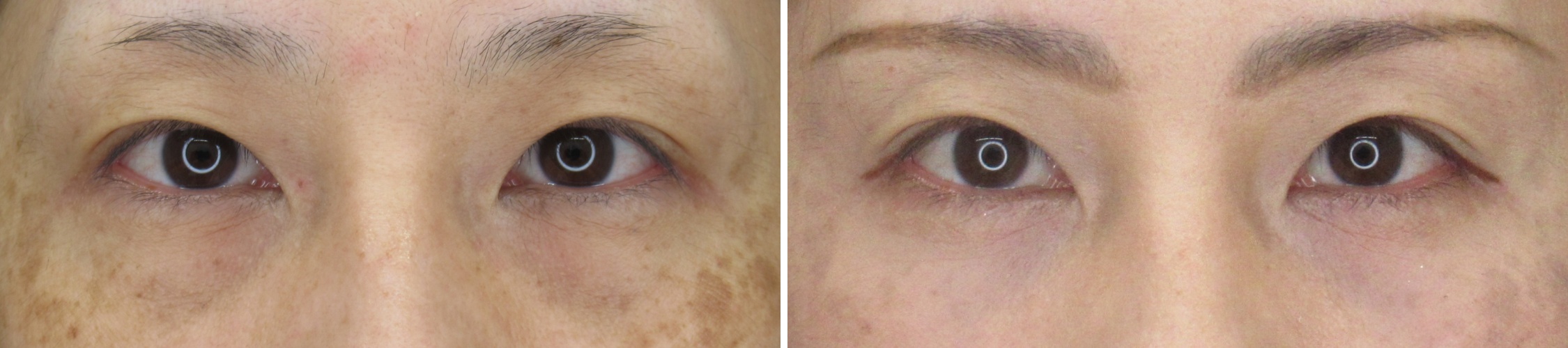 下眼瞼脱脂術で若々しいお目元