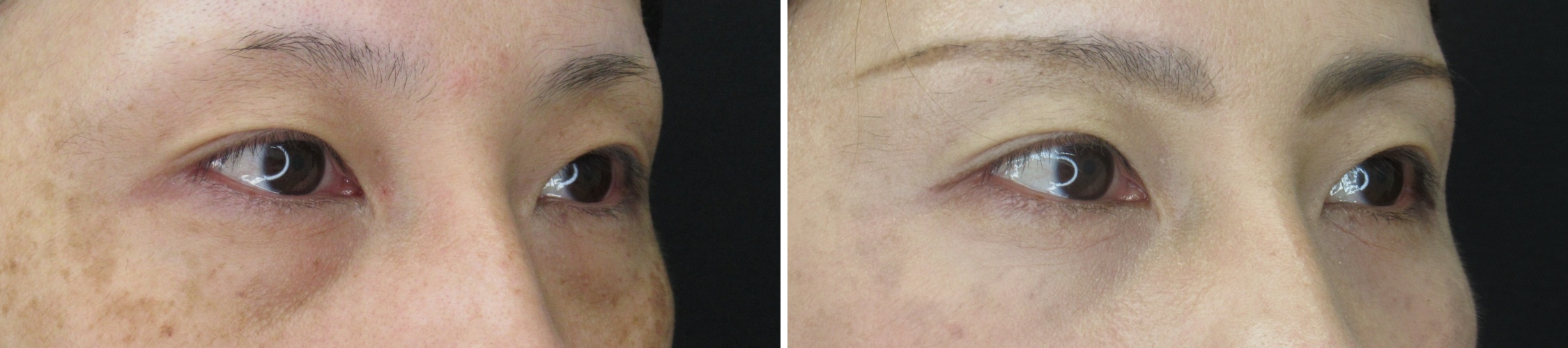 下眼瞼脱脂術（目の下のたるみ取り・目の下の脂肪ふくらみ取り）の症例写真 施術前後 １ヵ月