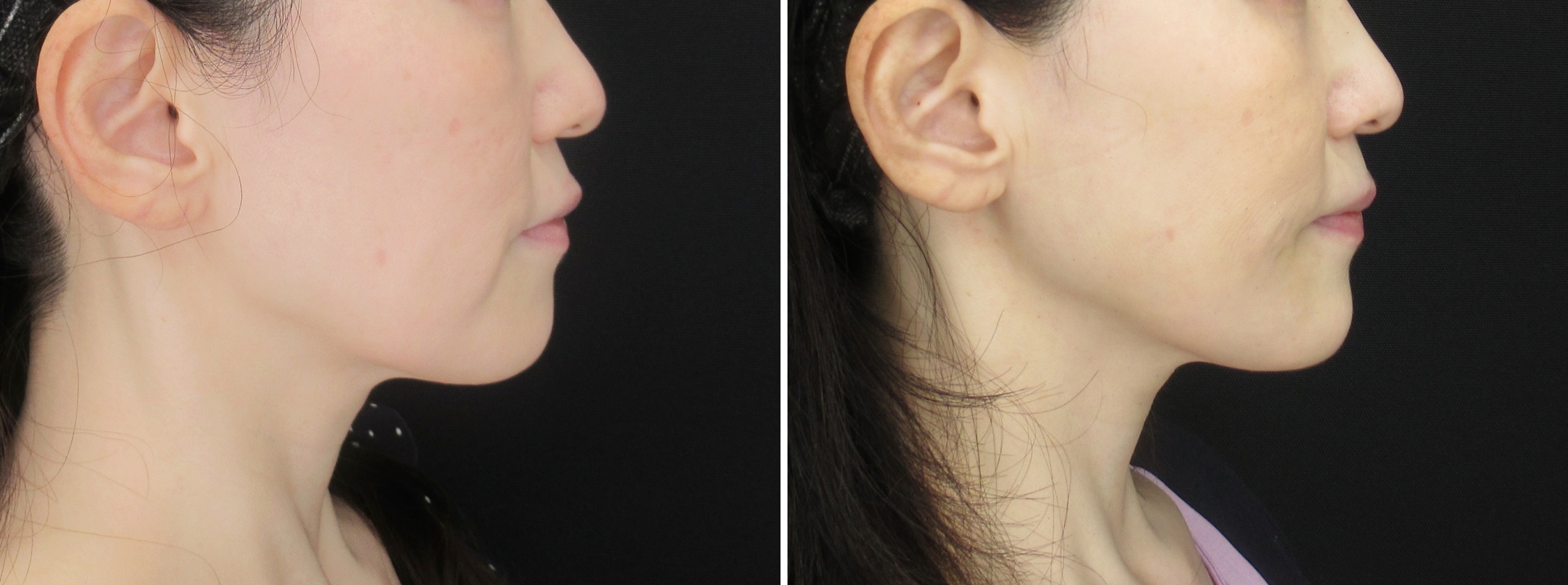 TAC式 ツヤ肌コラーゲンリフト®/ジョールファット除去/エラボトックス注射の症例写真 施術前後 
