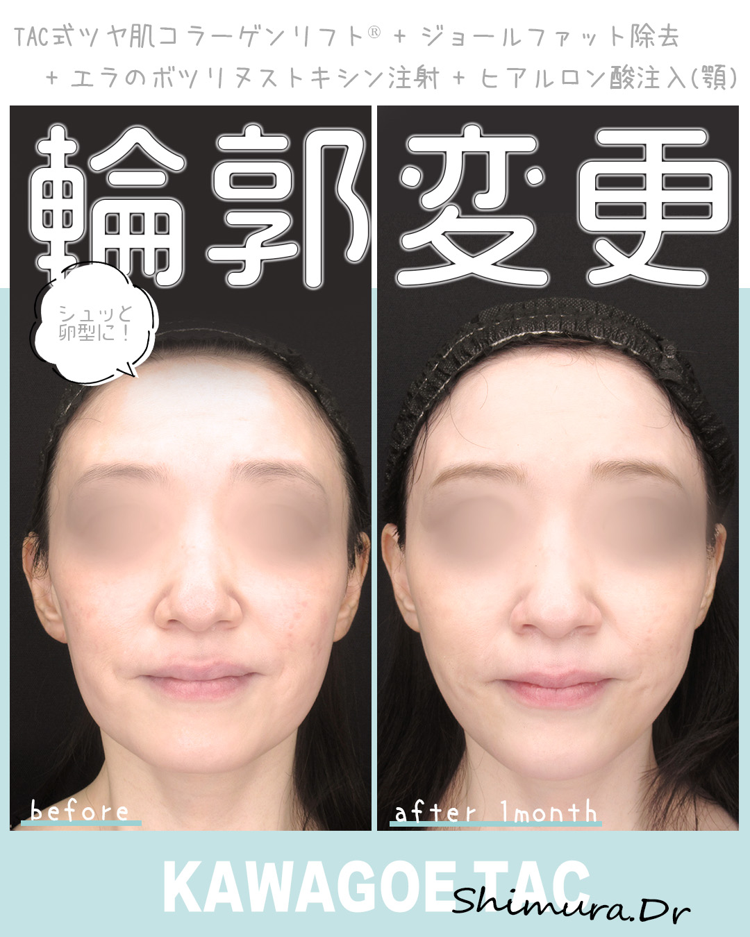 TAC式 ツヤ肌コラーゲンリフト®/ジョールファット除去/エラボトックス注射の症例写真 施術前後 