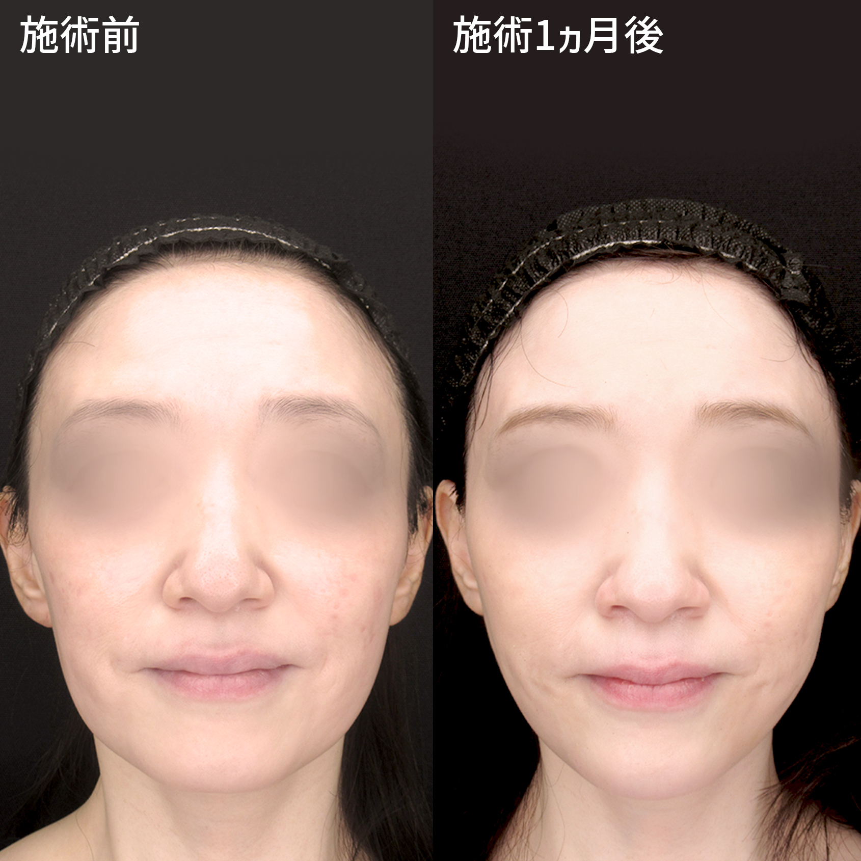 複合施術で若返りと小顔も実現