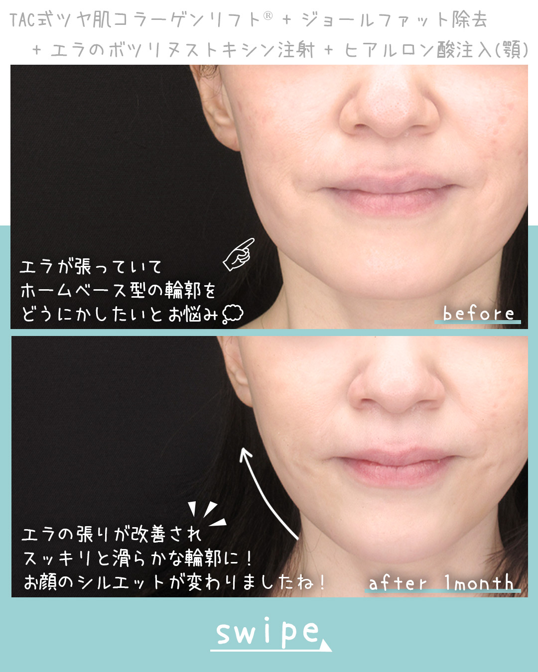 TAC式 ツヤ肌コラーゲンリフト®/ジョールファット除去/エラボトックス注射の症例写真 施術前後 