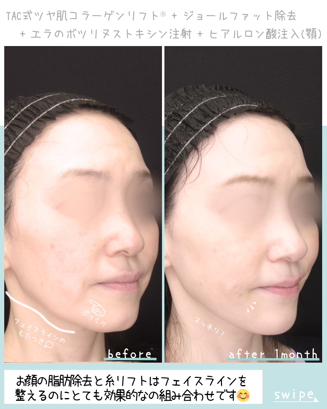 TAC式 ツヤ肌コラーゲンリフト®/ジョールファット除去/エラボトックス注射の症例写真 施術前後 