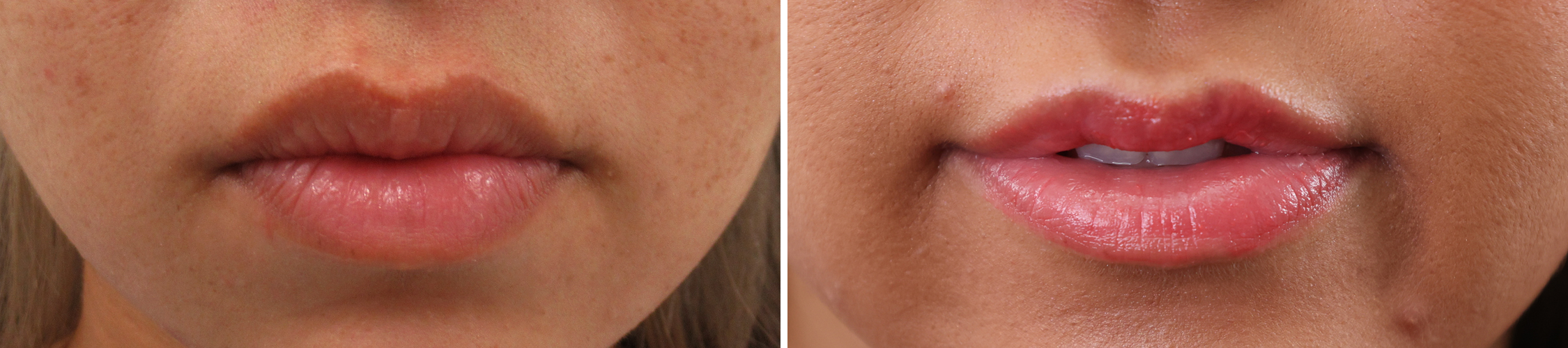 口角リフトとM字リップ形成術の合わせ技で女性らしい唇に！！