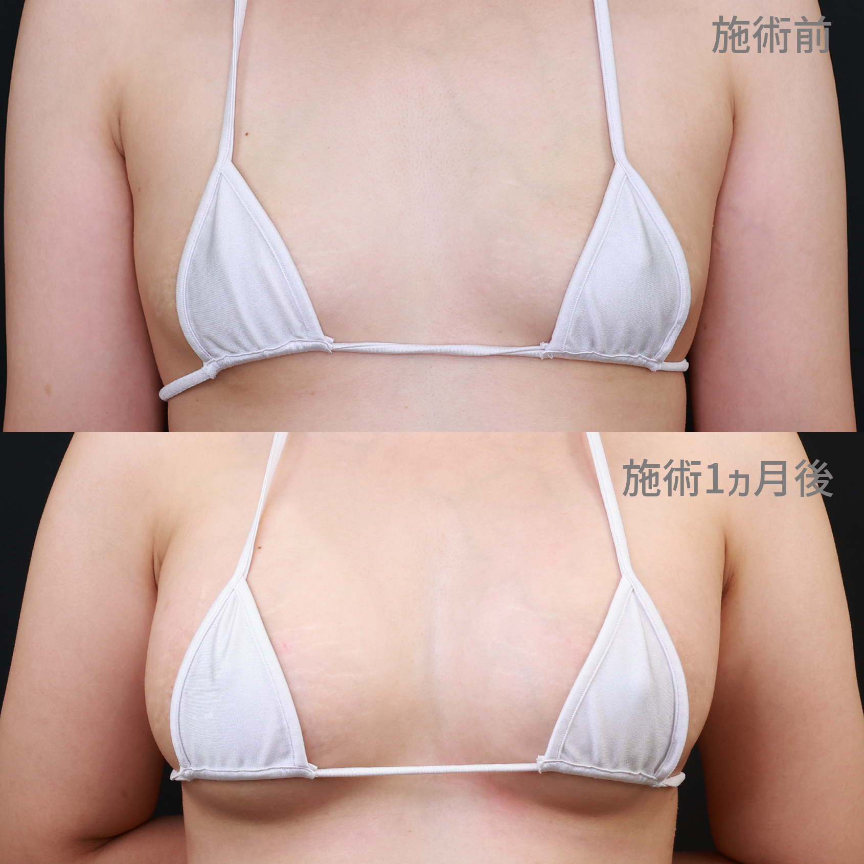 シリコンバッグ豊胸（人工乳腺バッグ）/乳頭縮小術の症例写真 施術前後 1ヵ月