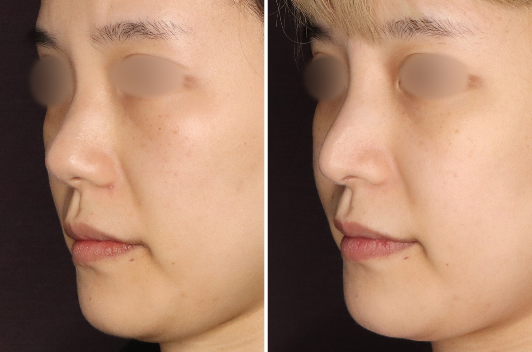 鼻中隔延長術で鼻先の角度を変えて大人っぽい印象に