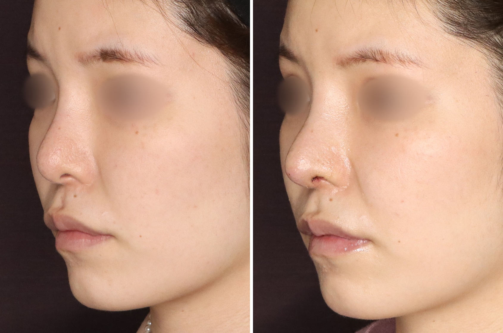 鼻中隔延長術と鼻尖形成、軟骨移植でアップノーズの華やか鼻