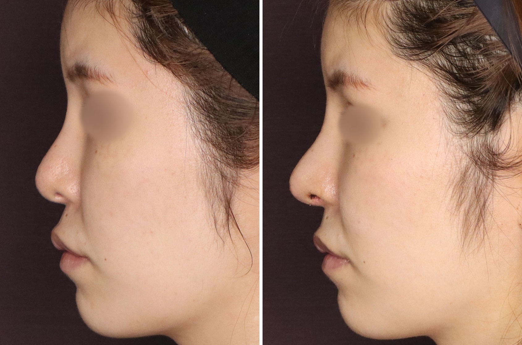 鼻中隔延長術/鼻尖形成・鼻尖縮小/鼻先軟骨移植の症例写真 施術前後 １週間