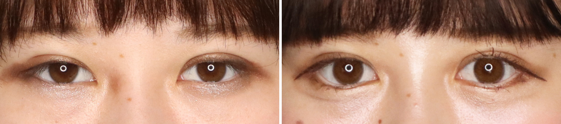 グラマラスライン（タレ目形成）/目尻切開術の症例写真 施術前後 １ヵ月