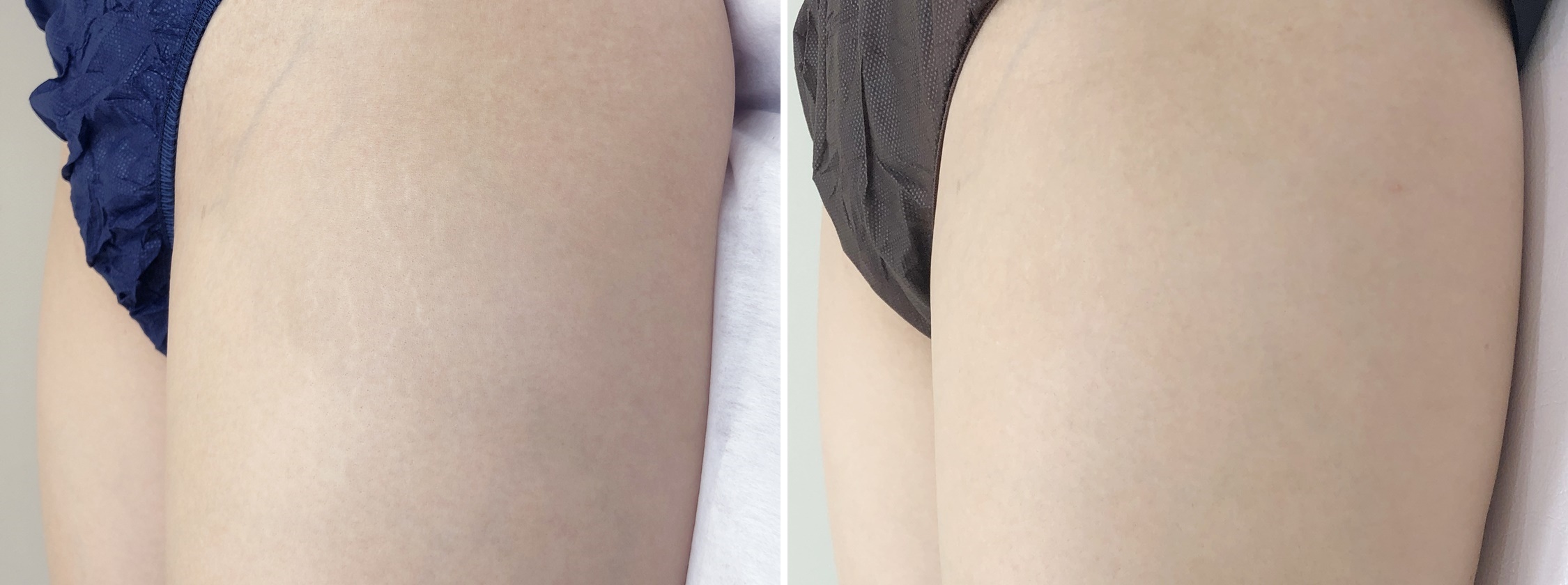 傷跡修正アートメイク-skin52-　美容大国 韓国から来た最新のアートメイク