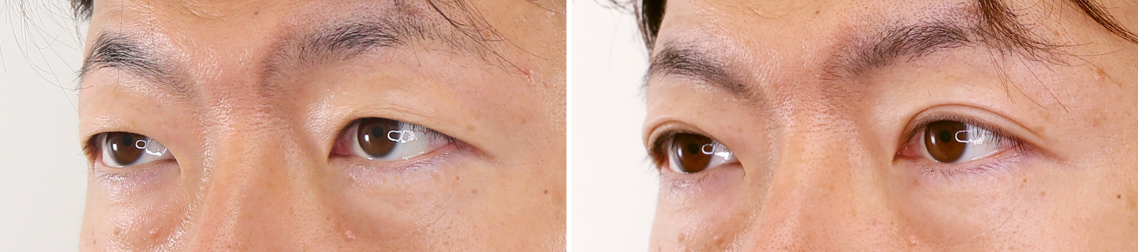 40代で手に入れた、おとなの色気漂うダンディーな二重瞼！！