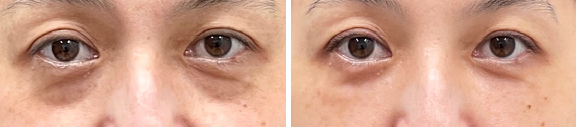 下眼瞼脱脂術と脂肪注入で 切らずに効果が持続する目の下のクマ治療