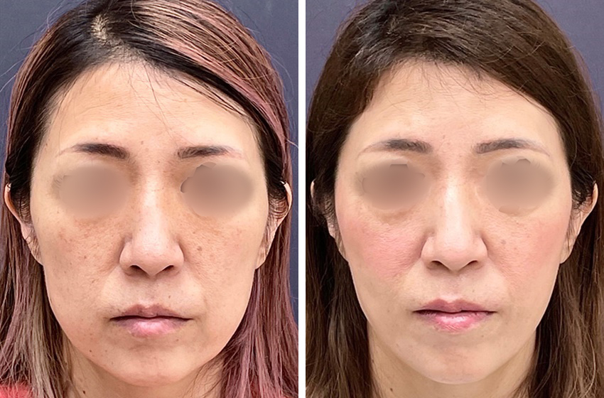 面長な印象を変える ツヤ肌コラーゲンリフトとジョールファット除去