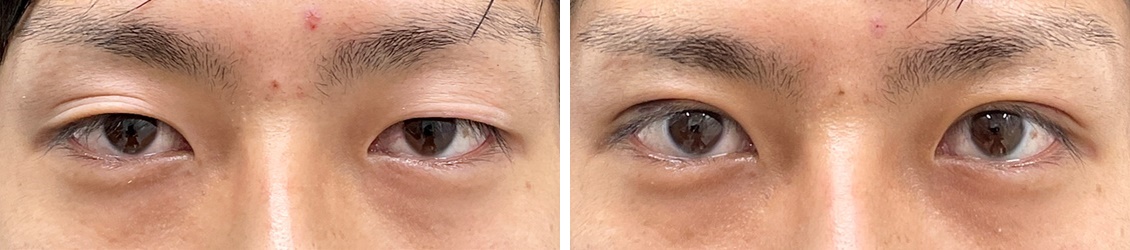 目力UPでイケメン度もUP！クイックコスメリング(二重埋没法)