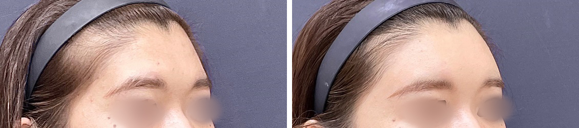 額こめかみのコンデンスリッチ脂肪注入 美しい横顔をつくるポイントは“おでこの丸み”