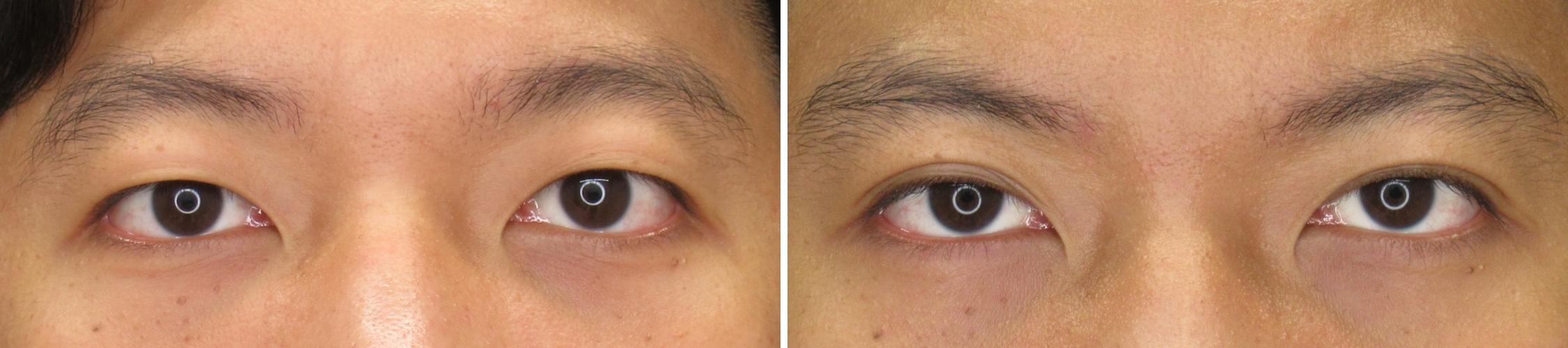 埋没法で自然に目力アップ