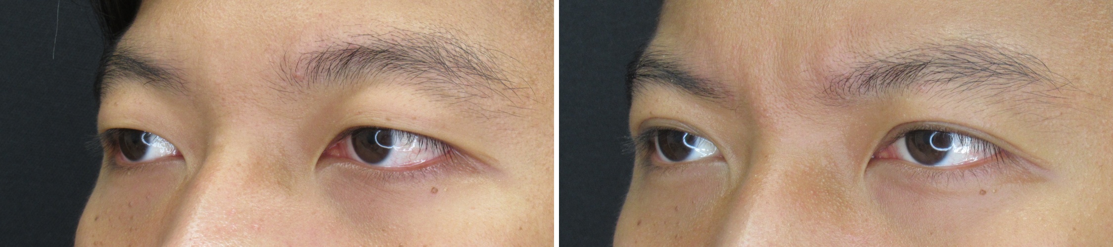 二重埋没法/目元：その他の症例写真 施術前後 1ヵ月