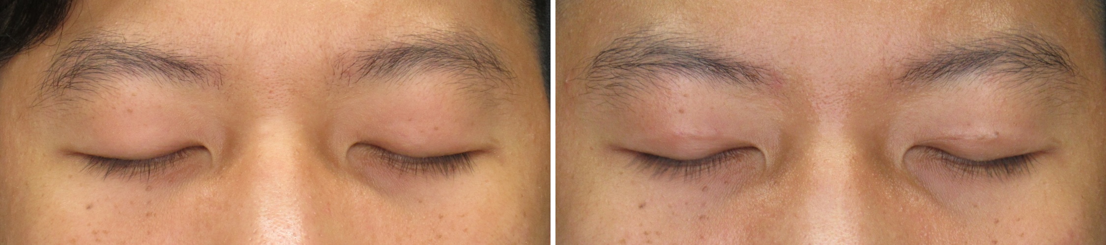 二重埋没法/目元：その他の症例写真 施術前後 1ヵ月