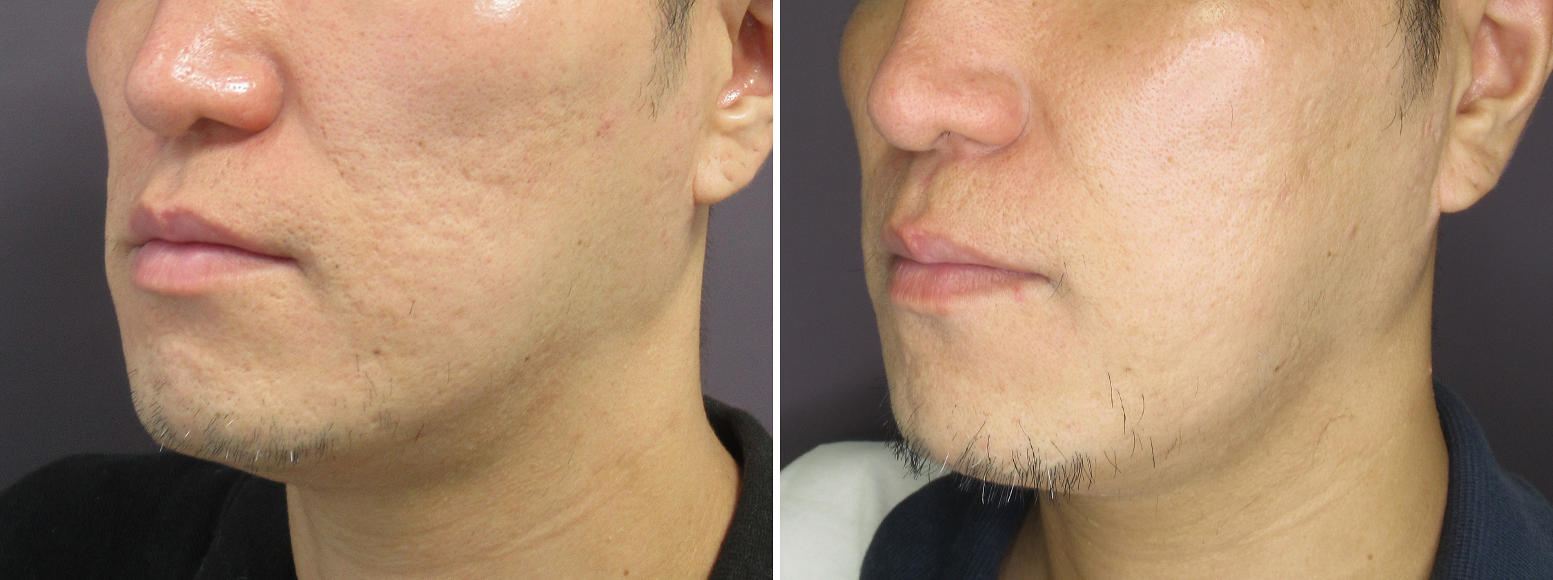 お肌のお悩みも人気のヴァンパイアフェイシャルで改善