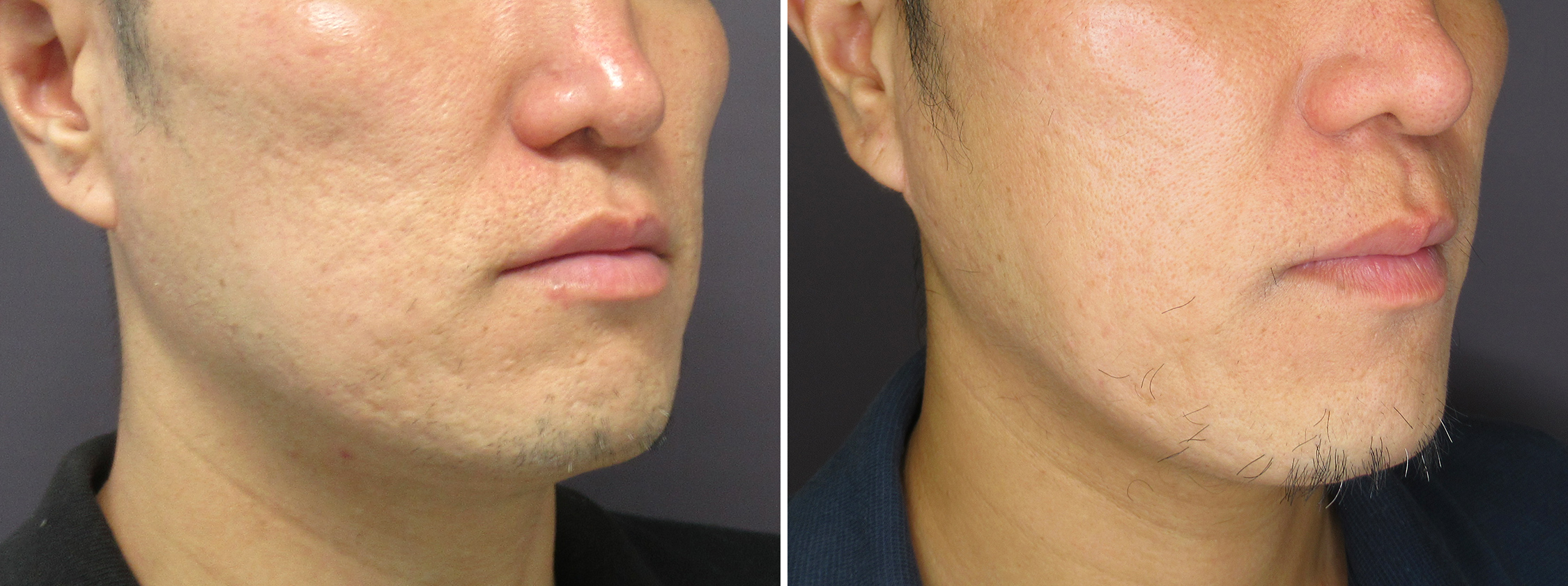 ヴァンパイアフェイシャル/ダーマペン4/エクソソーム/ベルベットスキンの症例写真 施術前後 １回目術後１ヶ月