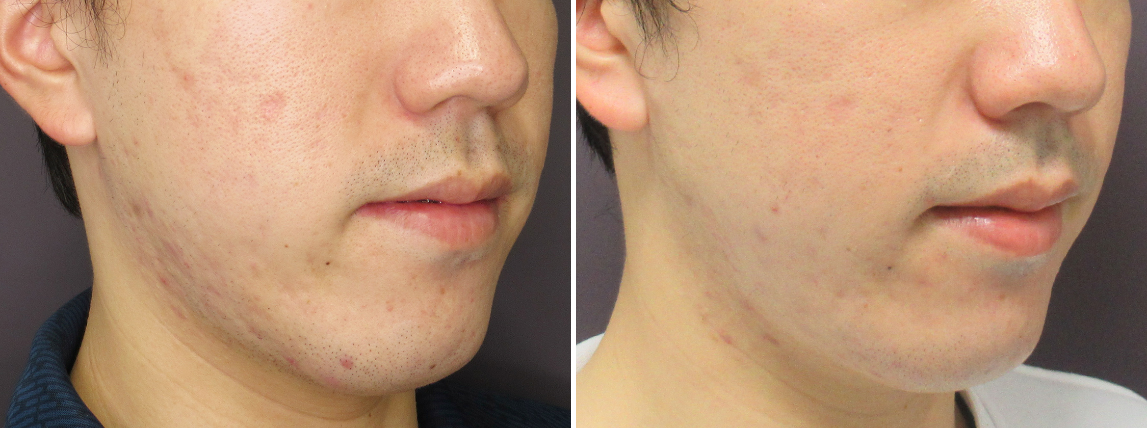 ヴァンパイアフェイシャルの症例写真 施術前後 ３回目施術前