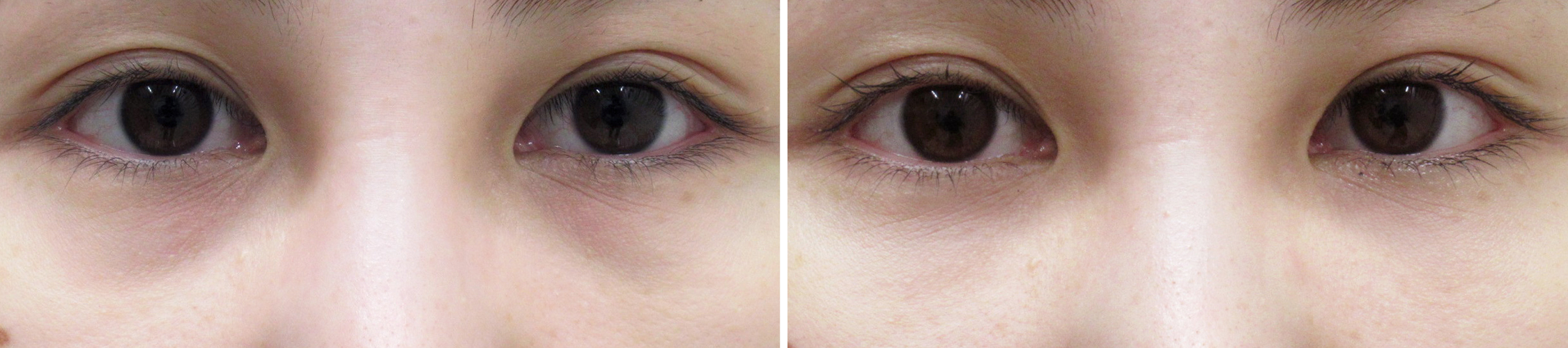 見た目年齢を左右する目の下のクマは下眼瞼脱脂術と脂肪注入で改善