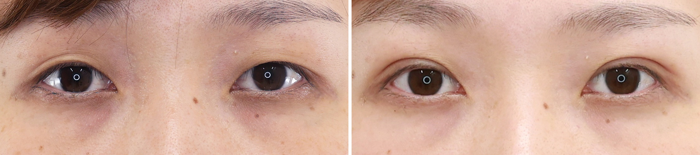 二重埋没法で 汗にも水にも負けない二重に