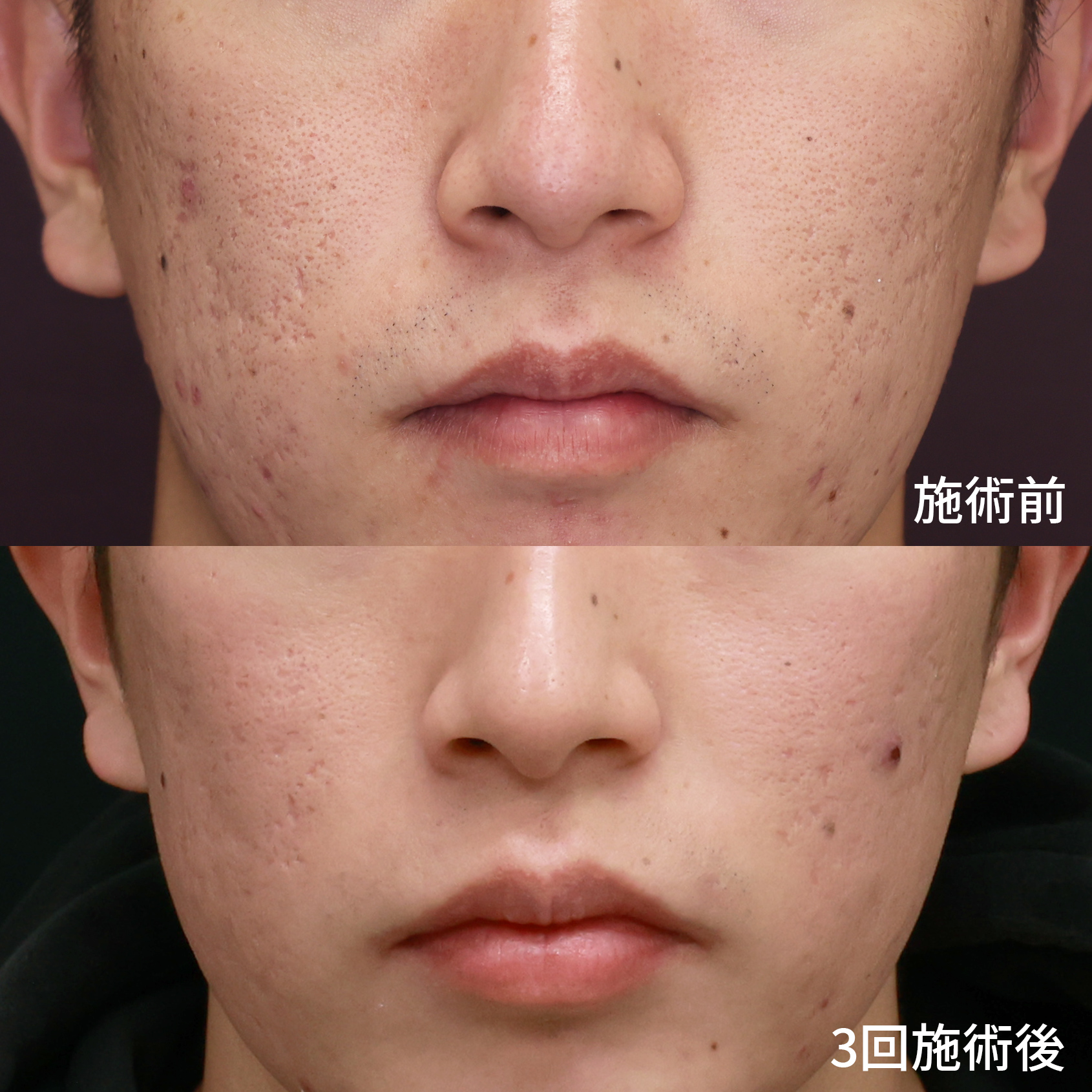 ヴァンパイアフェイシャル/ダーマペン4/エクソソーム/ベルベットスキンの症例写真 施術前後 
