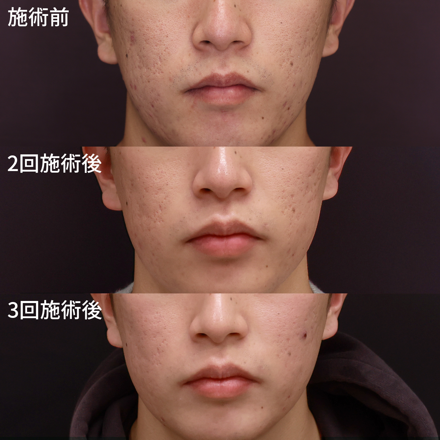 ヴァンパイアフェイシャル/ダーマペン4/エクソソーム/ベルベットスキンの症例写真 施術前後 