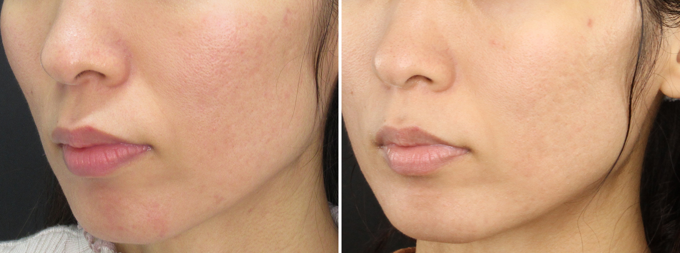 肌質改善したい方にオススメ★ヴァンパイアフェイシャル