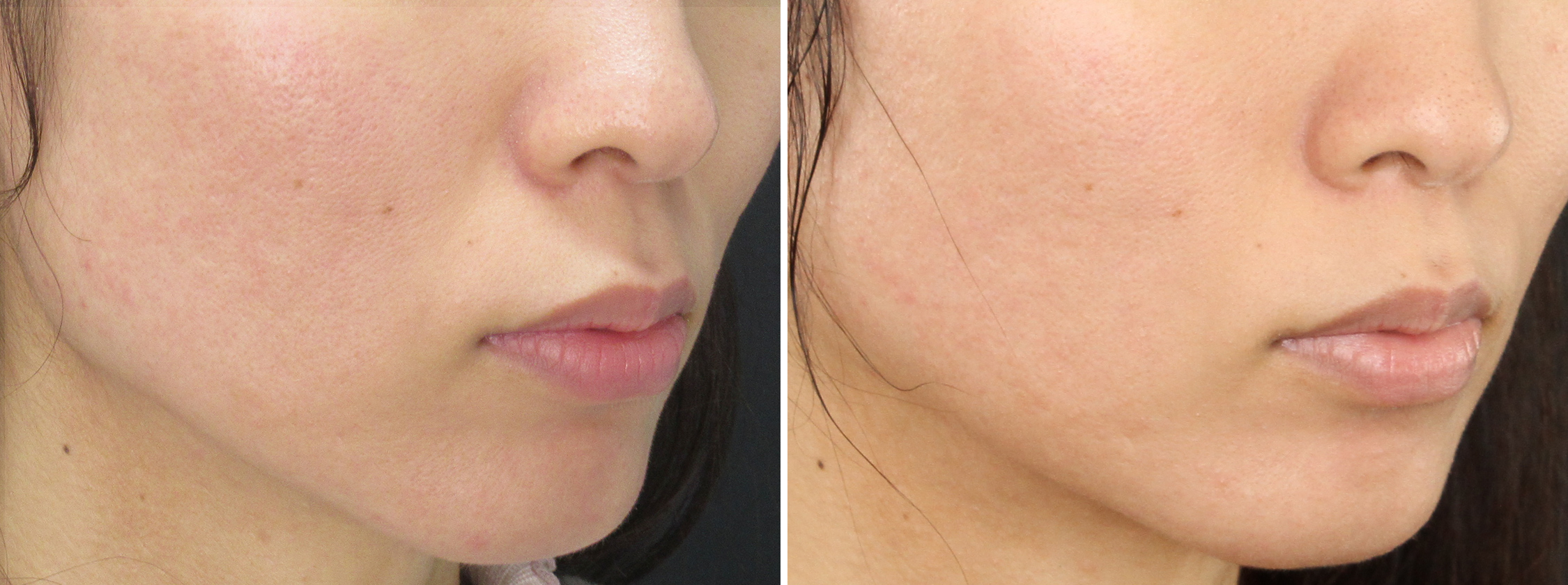 ヴァンパイアフェイシャル/ダーマペン4/エクソソーム/ベルベットスキンの症例写真 施術前後 ２回目施術後１カ月半