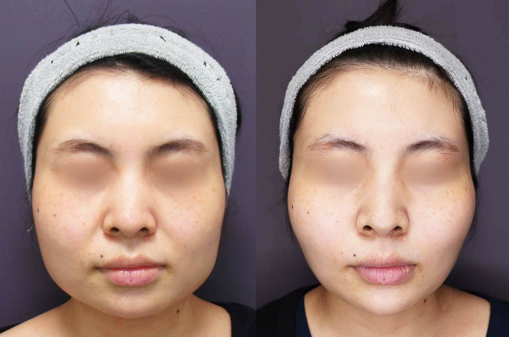 バッカルファット除去/顔の脂肪吸引/TAC式 ツヤ肌コラーゲンリフト®の症例写真 施術前後 １ヵ月