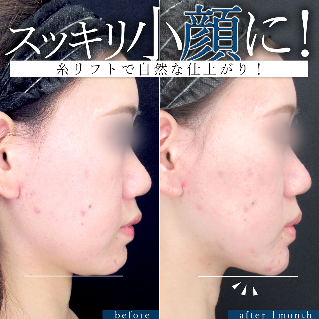 TAC式 ツヤ肌コラーゲンリフト®/バッカルファット除去/顎のヒアルロン酸注射の症例写真 施術前後 