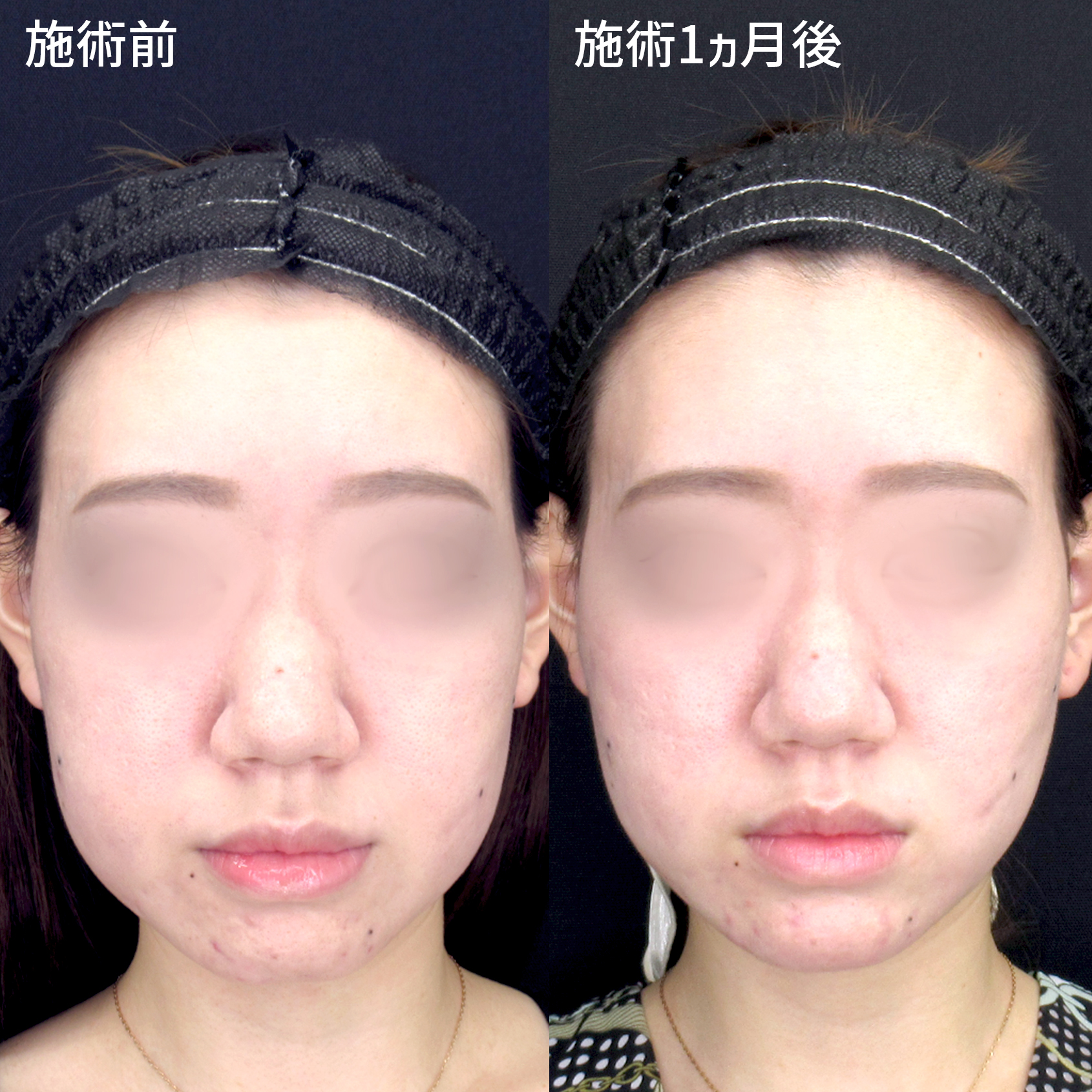 複合施術でお顔すっきり横顔美人