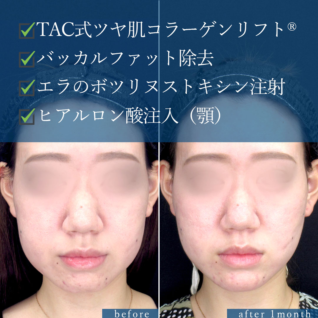 TAC式 ツヤ肌コラーゲンリフト®/バッカルファット除去/顎のヒアルロン酸注射の症例写真 施術前後 