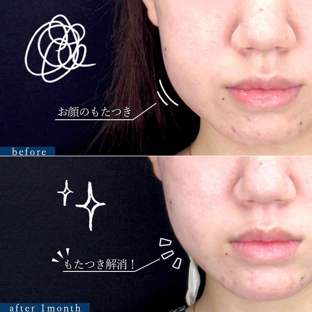 TAC式 ツヤ肌コラーゲンリフト®/バッカルファット除去/顎のヒアルロン酸注射の症例写真 施術前後 