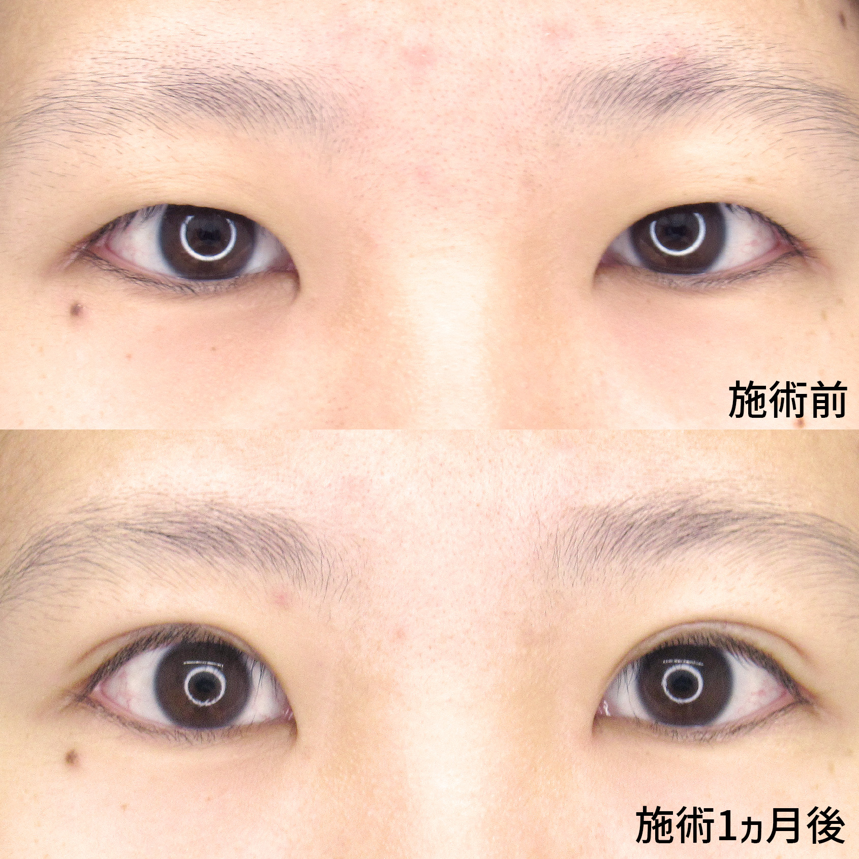 埋没法でひとまわり大きな目に