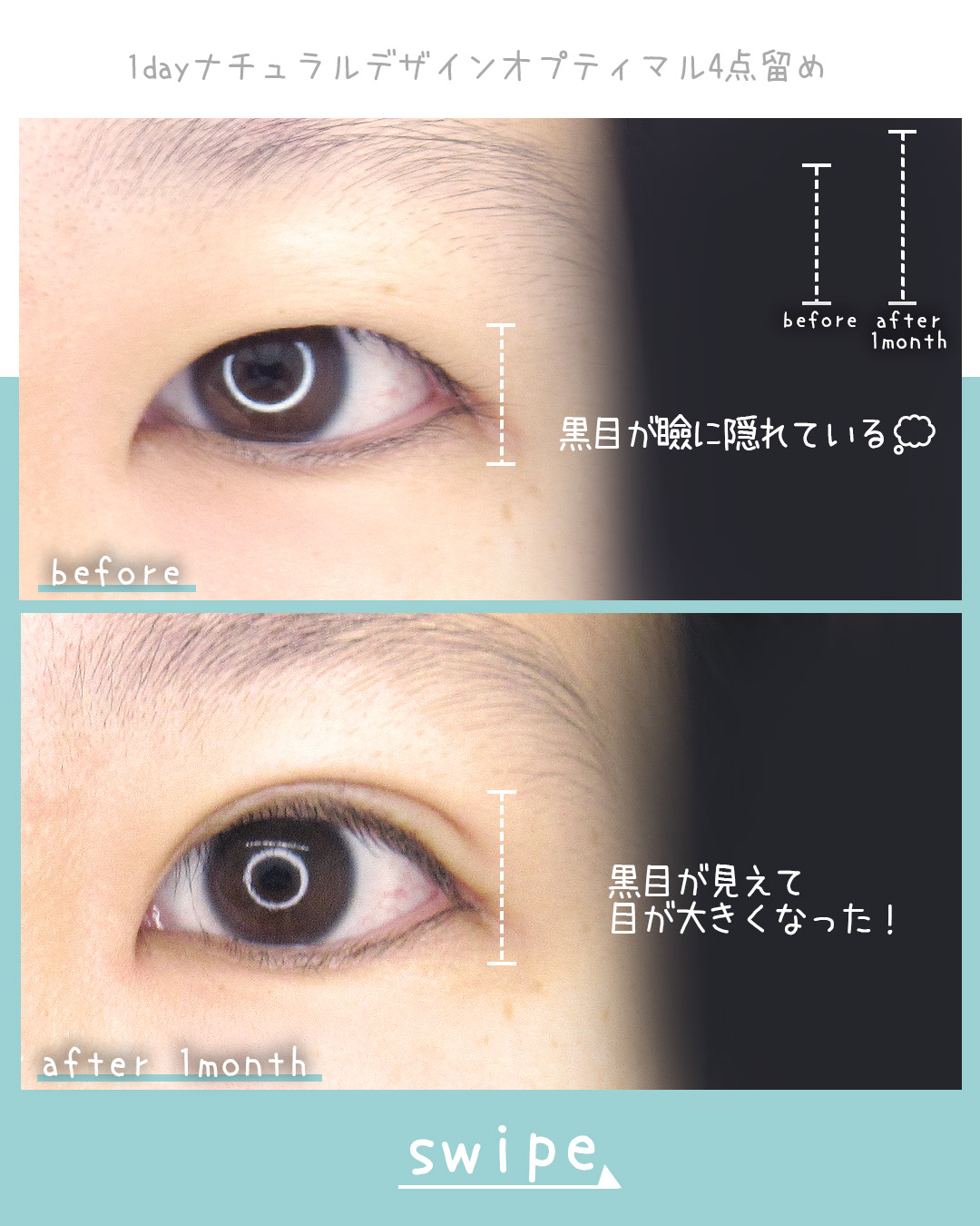 二重埋没法の症例写真 施術前後 